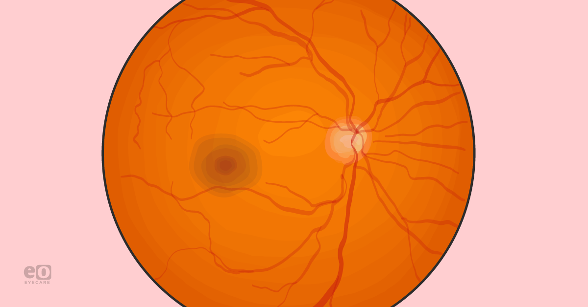 The Latest in the Surgical Management of Macular Holes